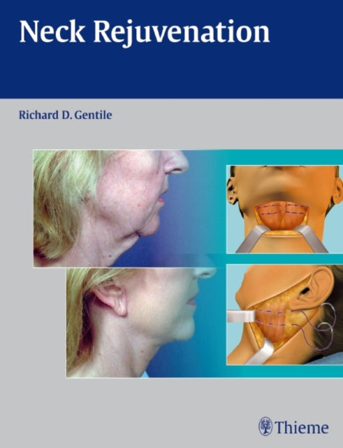 Book cover of: Neck Rejuvenation. By: Richard D. Gentile