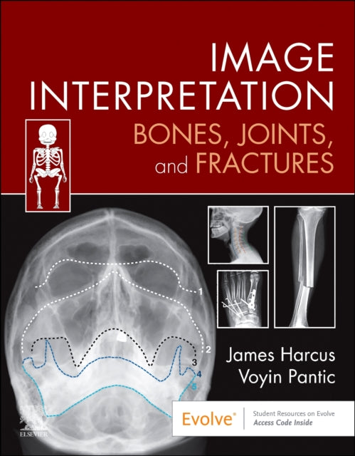 Book cover of: Image Interpretation: Bones, Joints, and Fractures. By: James Harcus