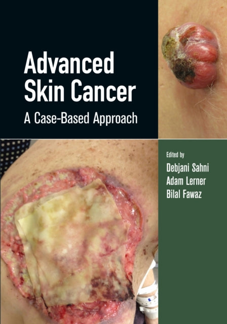 Book cover of: Advanced Skin Cancer. By: Debjani Sahni
