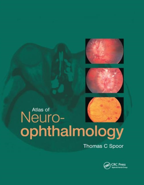 Book cover of: Atlas of Neuro-ophthalmology. By: Thomas C. Spoor