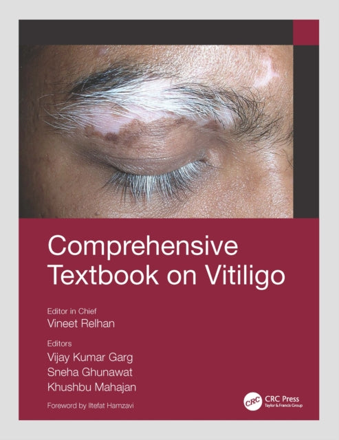 Book cover of: Comprehensive Textbook on Vitiligo. By: Vineet Relhan