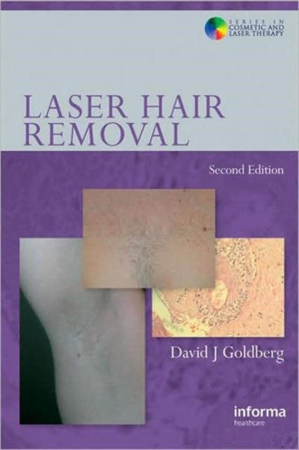 Book cover of: Laser Hair Removal. By: David J. Goldberg