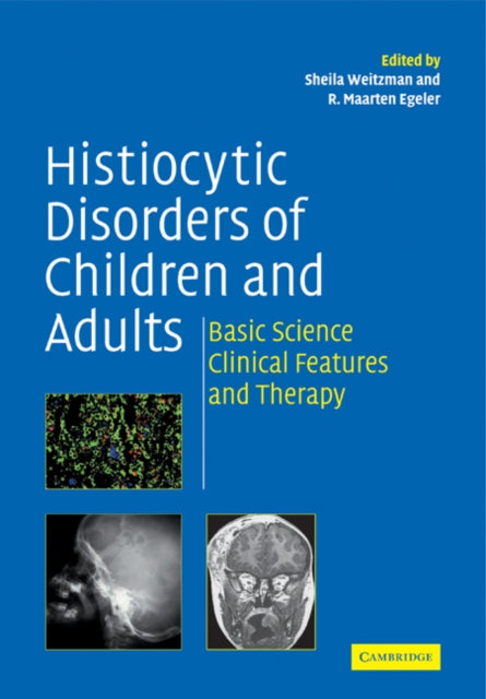 Book cover of: Histiocytic Disorders of Children and Adults. By: Sheila Weitzman