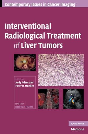 Interventional Radiological Treatment of Liver Tumors