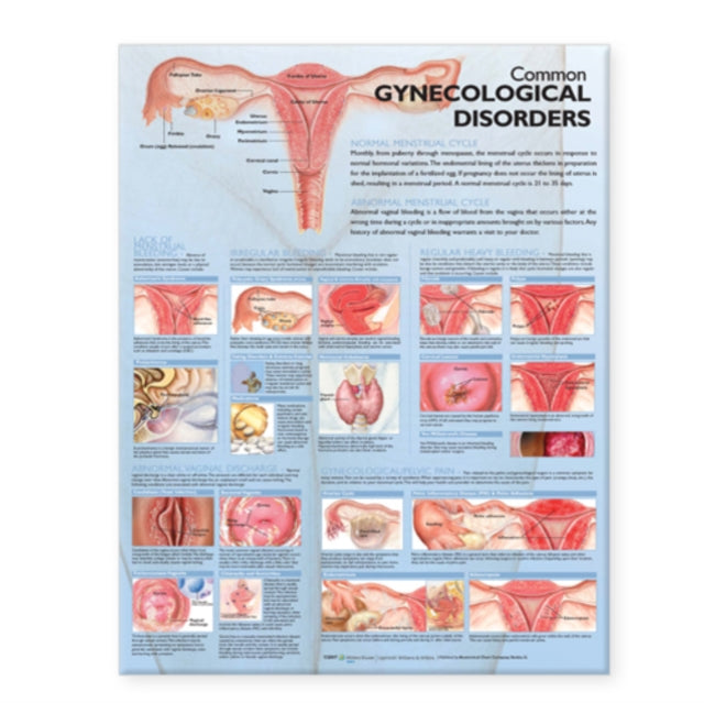 Book cover of: Common Gynecological Disorders Anatomical Chart
