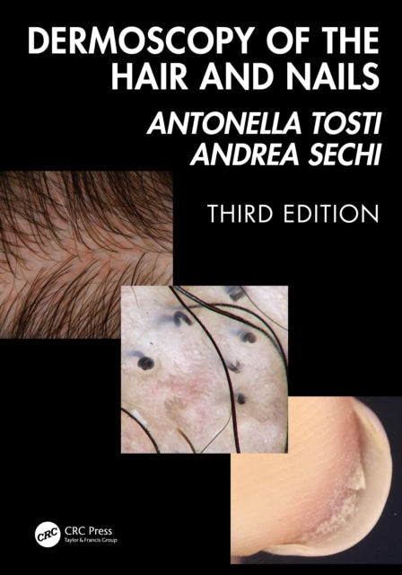 Dermoscopy of the Hair and Nails 3e