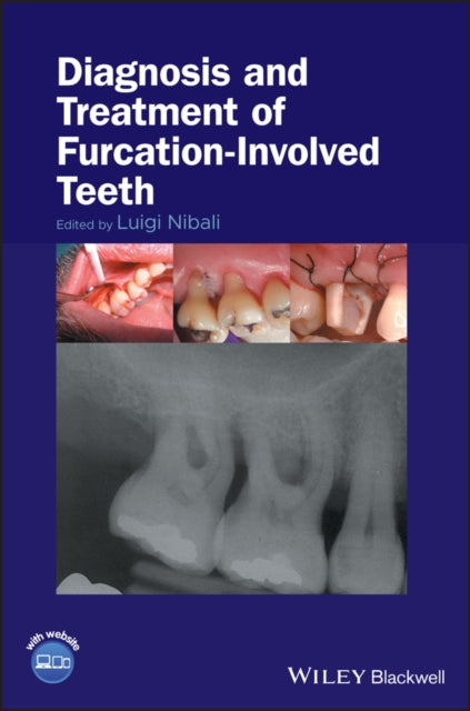 Book cover of: Diagnosis and Treatment of Furcation-Involved Teeth. By: Luigi Nibali