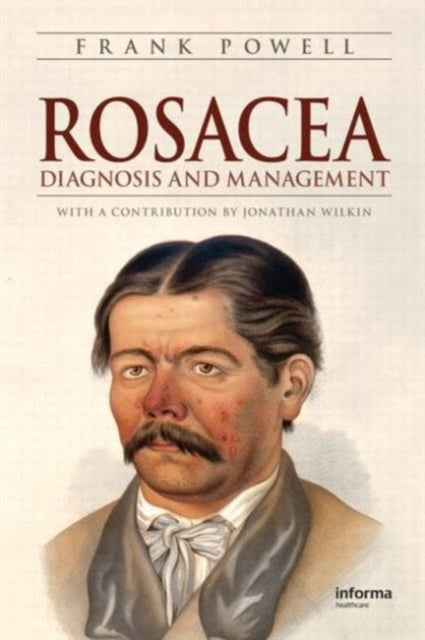 Book cover of: Rosacea. By: Frank Powell, Frank C. Powell