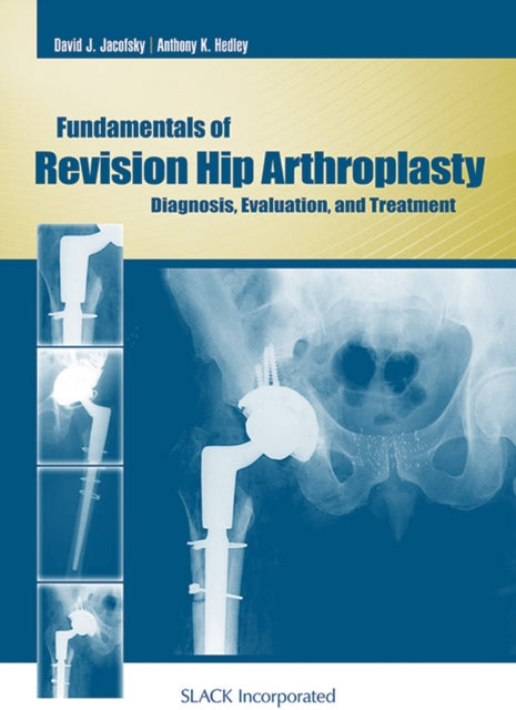 Book cover of: Fundamentals of Revision Hip Arthroplasty. By: David J. Jacofsky