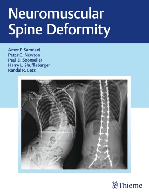 Book cover of: Neuromuscular Spine Deformity. By: Amer Samdani