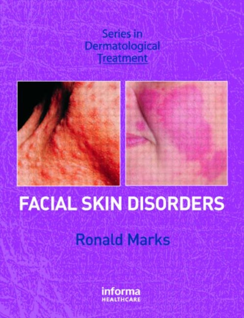 Book cover of: Facial Skin Disorders. By: Ronald Marks