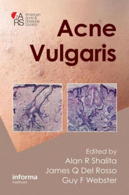Book cover of: Acne Vulgaris. By: Alan R. Shalita