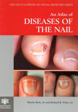 An Atlas of Diseases of the Nail