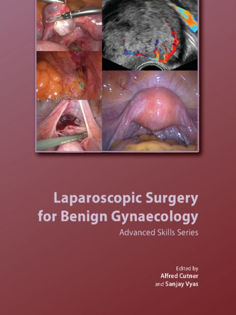 Book cover of: Laparoscopic Surgery for Benign Gynaecology Hardback with DVDs. By: Alfred Cutner
