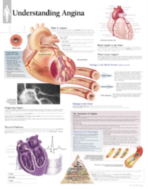 Book cover of: Understanding Angina Paper Poster. By: Scientific Publishing