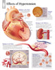 Book cover of: Effects of Hypertension Laminated Poster. By: Scientific Publishing