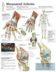 Book cover of: Rheumatoid Arthritis Laminated Poster