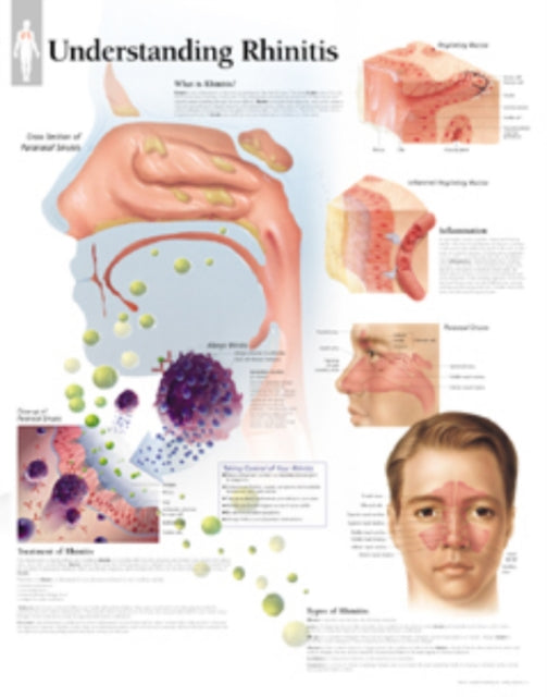 Book cover of: Understanding Rhinitis Laminated Poster. By: Scientific Publishing
