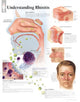 Book cover of: Understanding Rhinitis Laminated Poster. By: Scientific Publishing