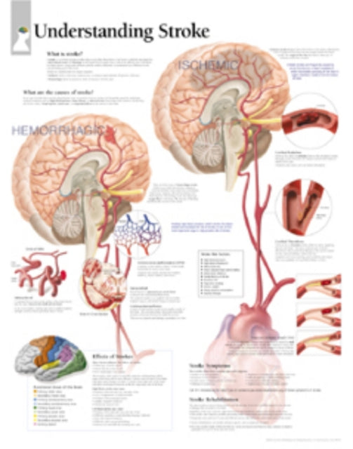 Book cover of: Understanding Stroke Laminated Poster. By: Scientific Publishing