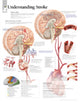 Book cover of: Understanding Stroke Laminated Poster. By: Scientific Publishing