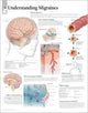 Book cover of: Understanding Migraines Laminated Poster. By: Scientific Publishing