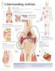 Book cover of: Understanding Arthritis Laminated Poster