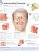 Book cover of: Understanding Sinusitis Paper Poster
