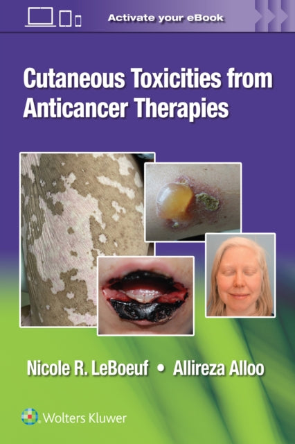 Book cover of: Cutaneous Toxicities from Anticancer Therapies. By: LEBEOUF