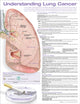 Book cover of: Understanding Lung Cancer Anatomical Chart
