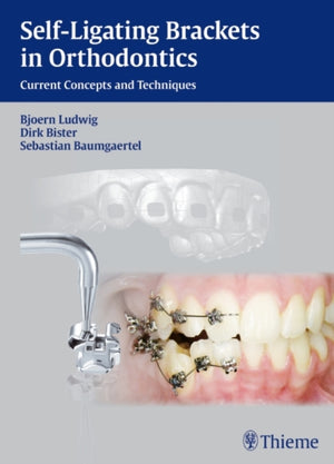 Self-ligating Brackets in Orthodontics