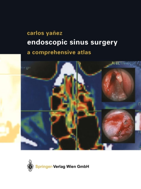 Book cover of: Endoscopic Sinus Surgery. By: Carlos Yañez