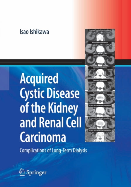 Book cover of: Acquired Cystic Disease of the Kidney and Renal Cell Carcinoma. By: Isao Ishikawa